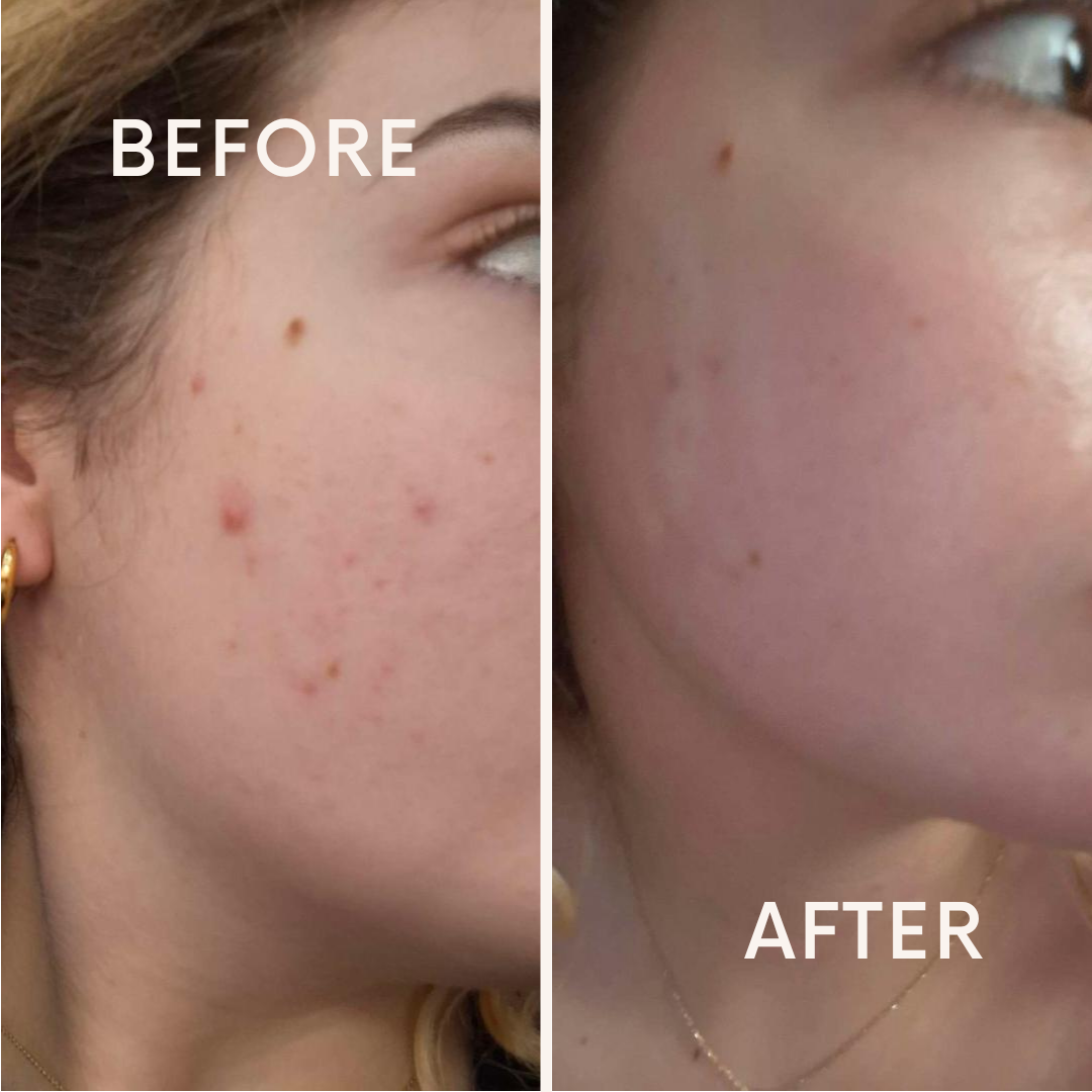 Anua Azelaic Acid 10 Hyaluron : Redness Soothing Serum